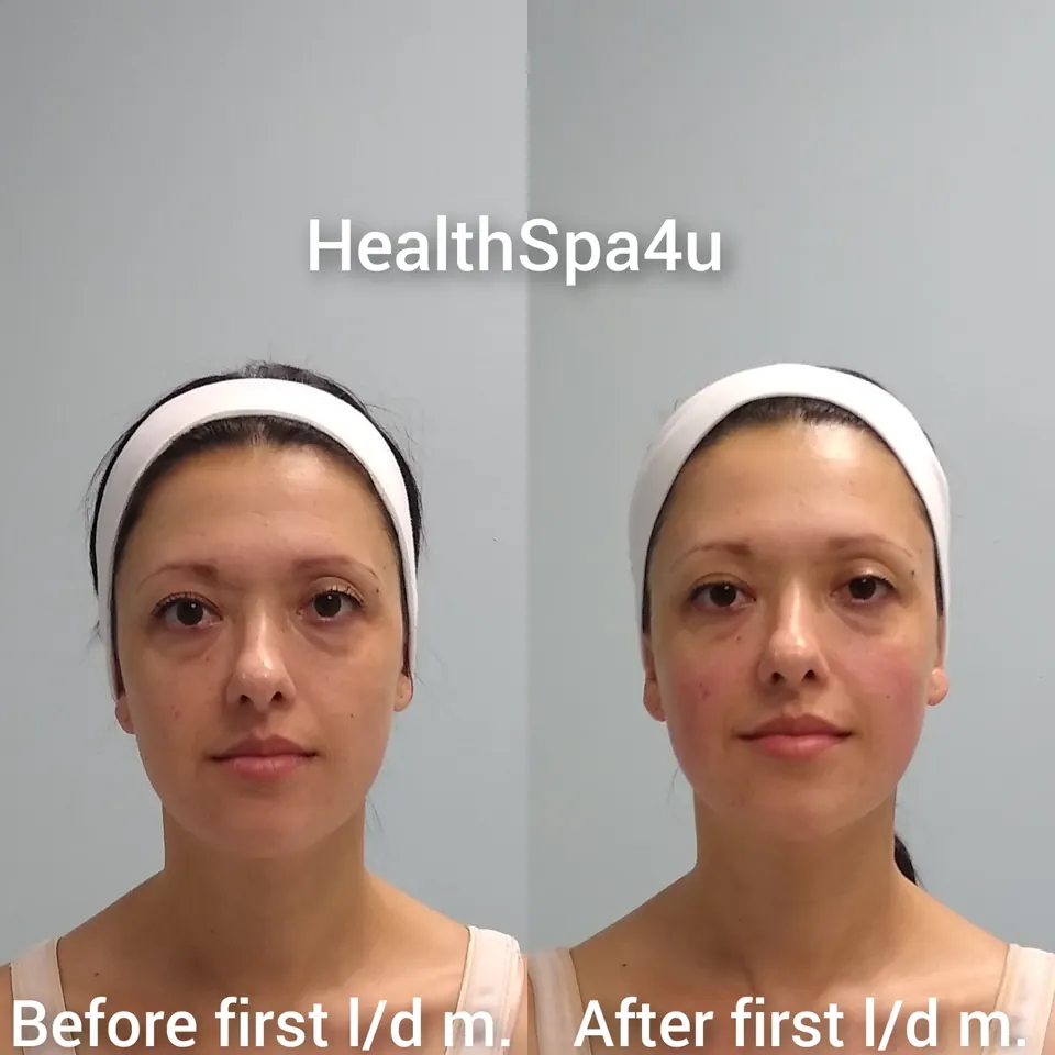 Effects of 1 MLD massage for face