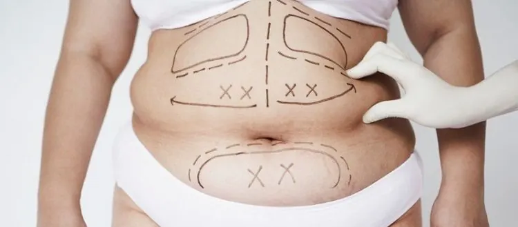 Body Lymphatic Drainage (Post-Lipo)