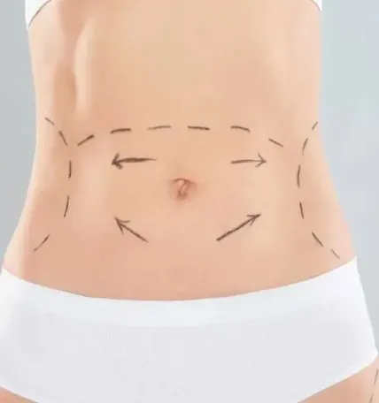 Why Lymphatic Massage is Your BFF After a Tummy Tuck